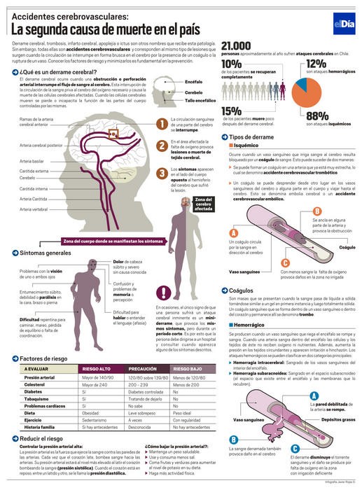 Infografía: Derrame cerebral