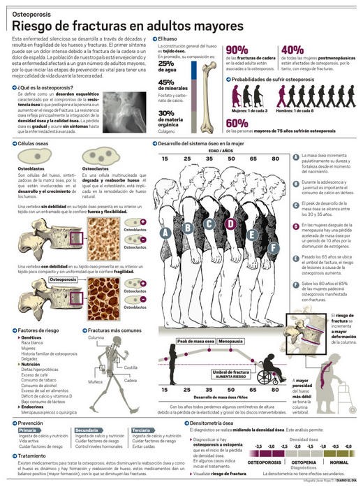 Infografía: La osteoporosis