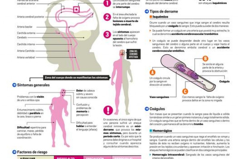 Infografía: Infarto cerebral:La segunda causa de muerte en el país