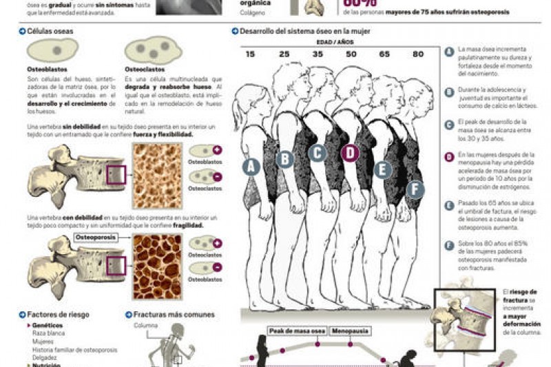 Infografía: La osteoporosis